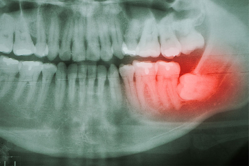 柴田歯科医院　難抜歯の特徴と対処法